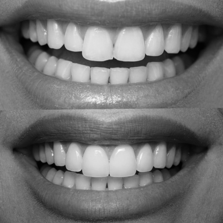 Before and after — smile transformation